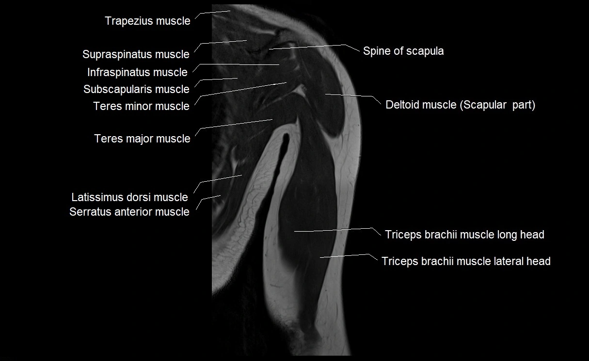 MRI upper arm (humerus ) coronal cross sectional anatomy image 23.webp
